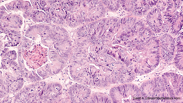 endometrial cancer